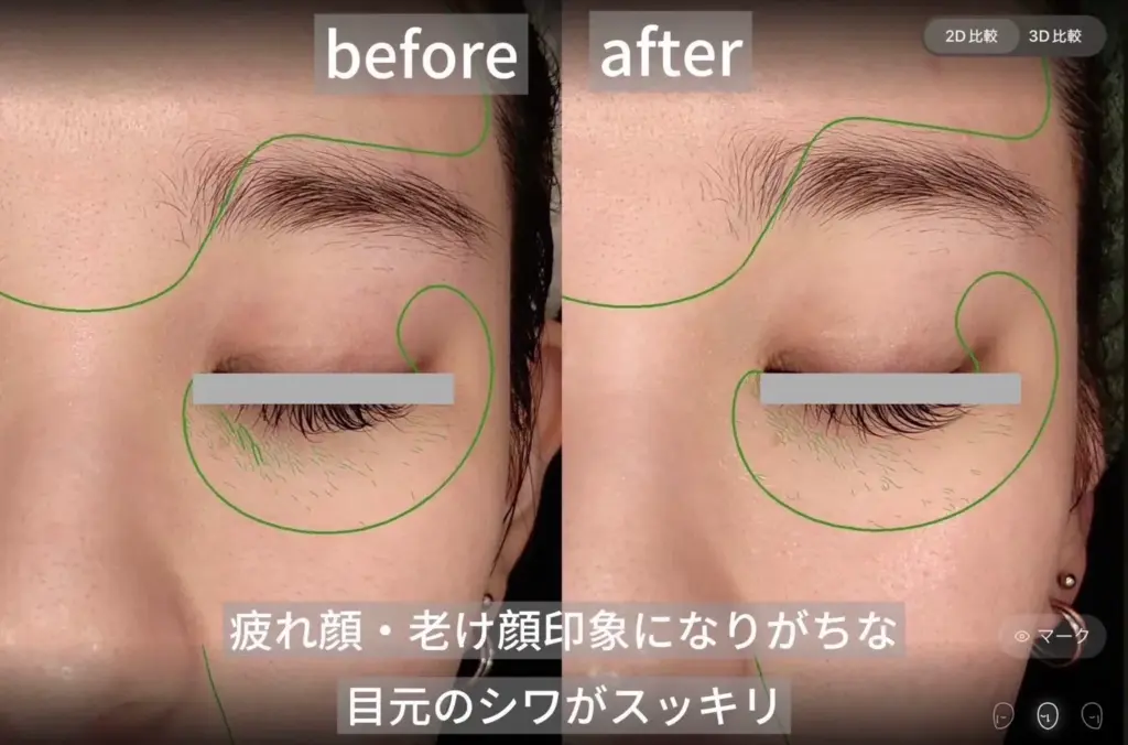 目元のシワ改善ビフォーアフター写真。疲れ顔や老け顔の印象が軽減し、施術後はハリのある若々しい目元に。