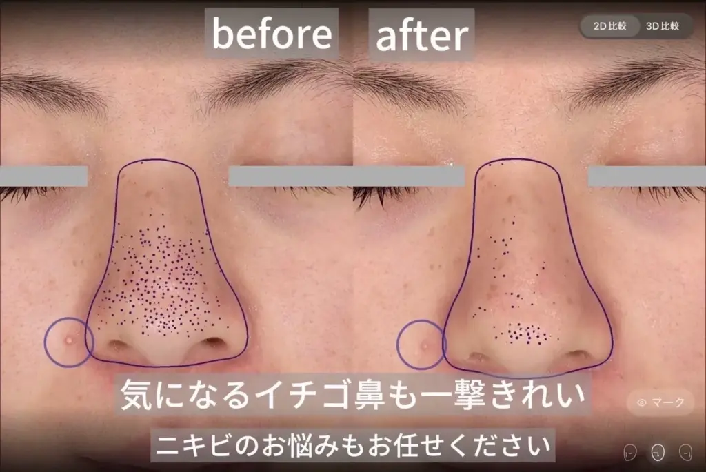 いちご鼻施術前後の比較画像：毛穴の黒ずみが改善され、なめらかになった肌。