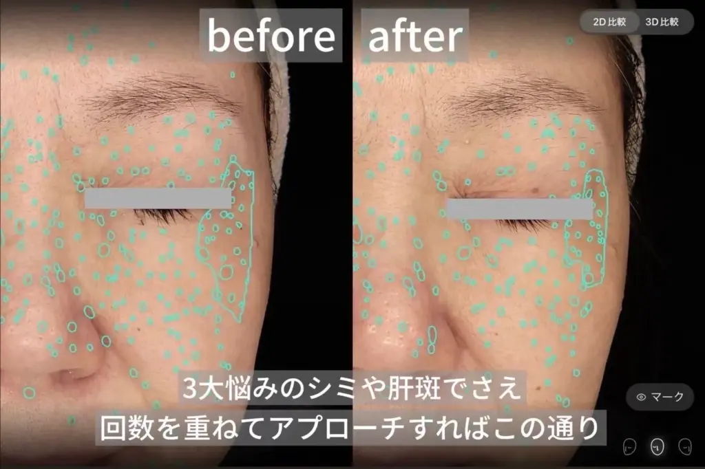 顔のシミや肝斑治療のbefore after比較写真。施術を重ねることで肌のシミが減少し、透明感が向上。