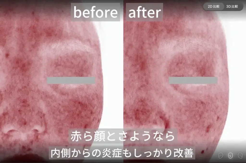 赤ら顔改善のbefore after写真。顔全体の赤みや炎症が軽減し、内側から肌トラブルを改善した症例。