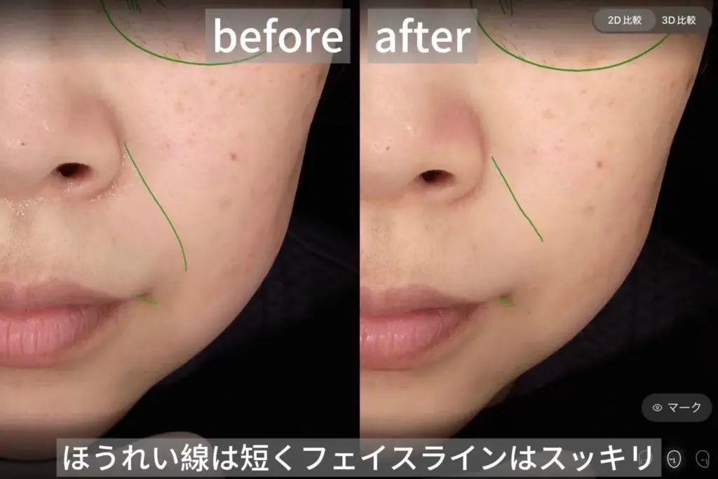 ほうれい線が短くなりフェイスラインが引き締まったbefore after写真。若々しい印象に変化。