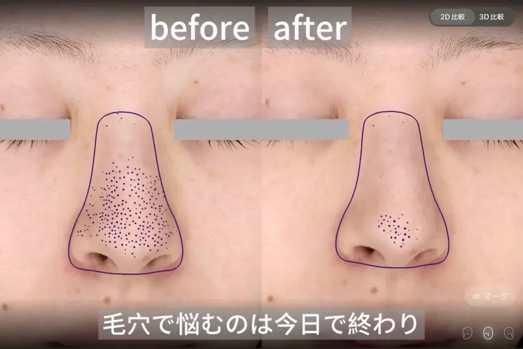 鼻の毛穴開き改善before after写真。施術後は毛穴が目立たなくなり、滑らかな肌に整った症例写真。