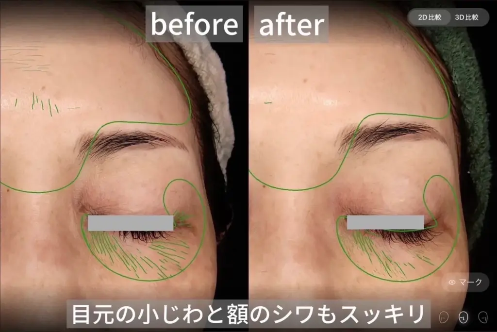 目元の小じわと額のシワ改善のbefore after比較。施術後はハリが出て若々しい印象に変化。