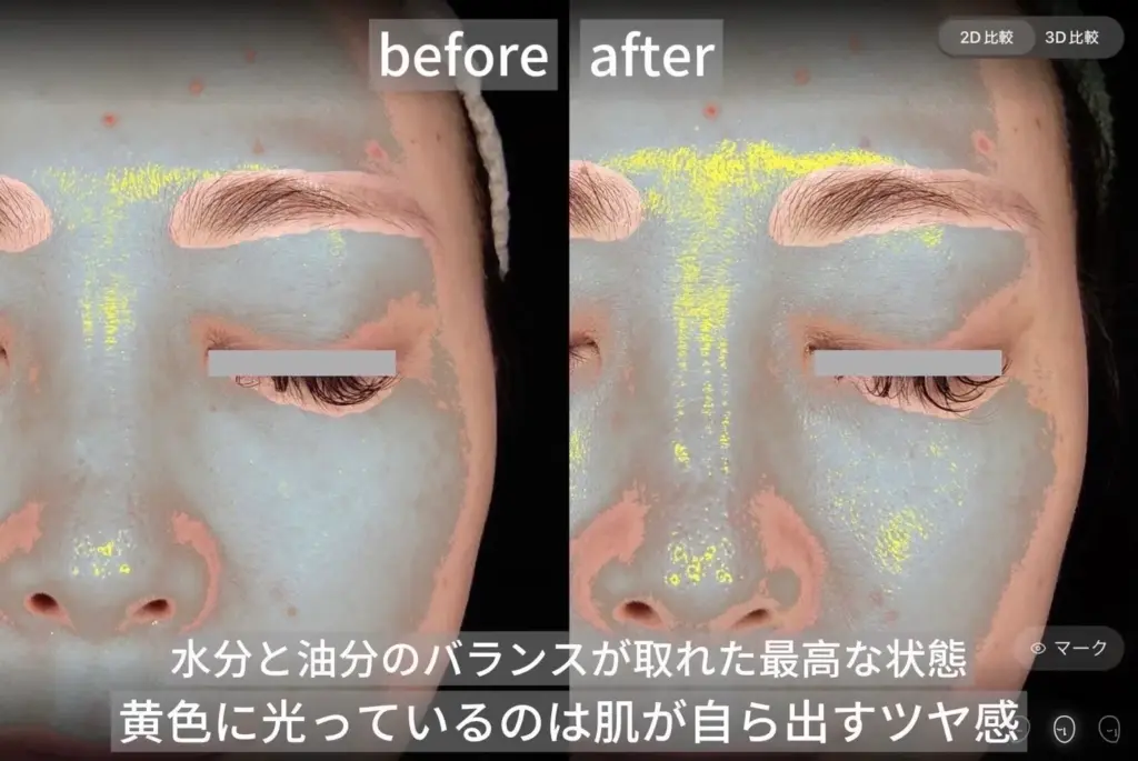肌の水分と油分バランス改善のbefore after写真。施術後は肌が自然にツヤを放ち、健康的な美肌状態に。